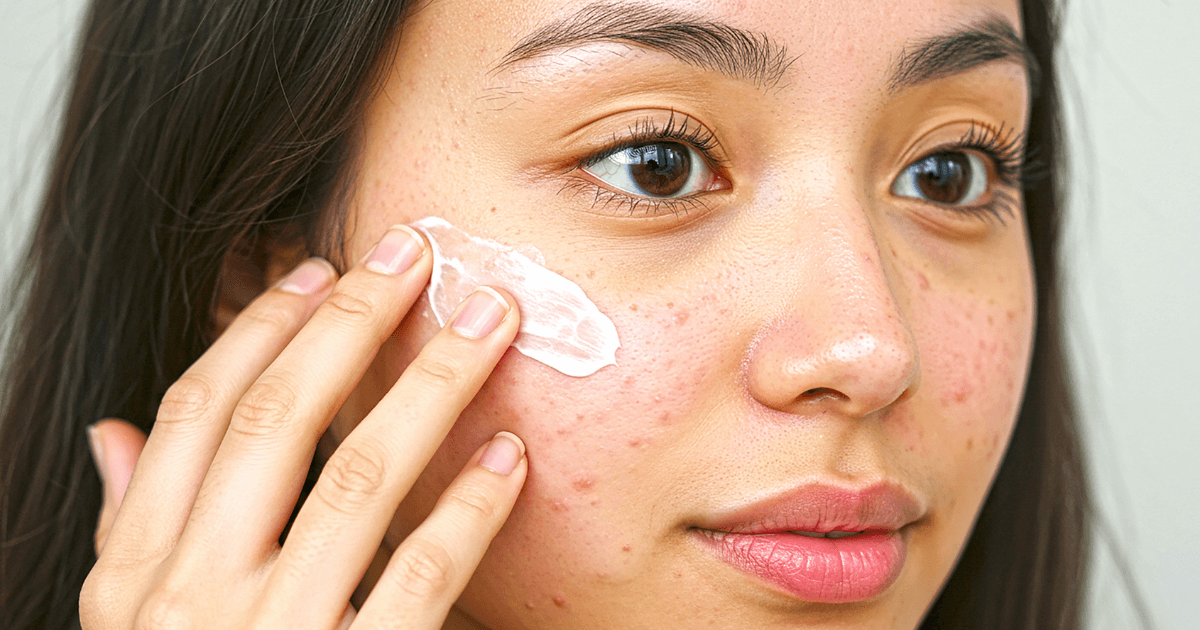 How to remove acne scars naturally, remove acne scars naturally, natural acne scar treatment, home remedies for acne scars, natural ways to remove acne scars, acne scar removal tips, clear skin remedies, acne scars home treatment, best natural remedies for acne scars, fade acne scars naturally, Beauty Tips, Ideal Beauty Tips, Beauty DIY