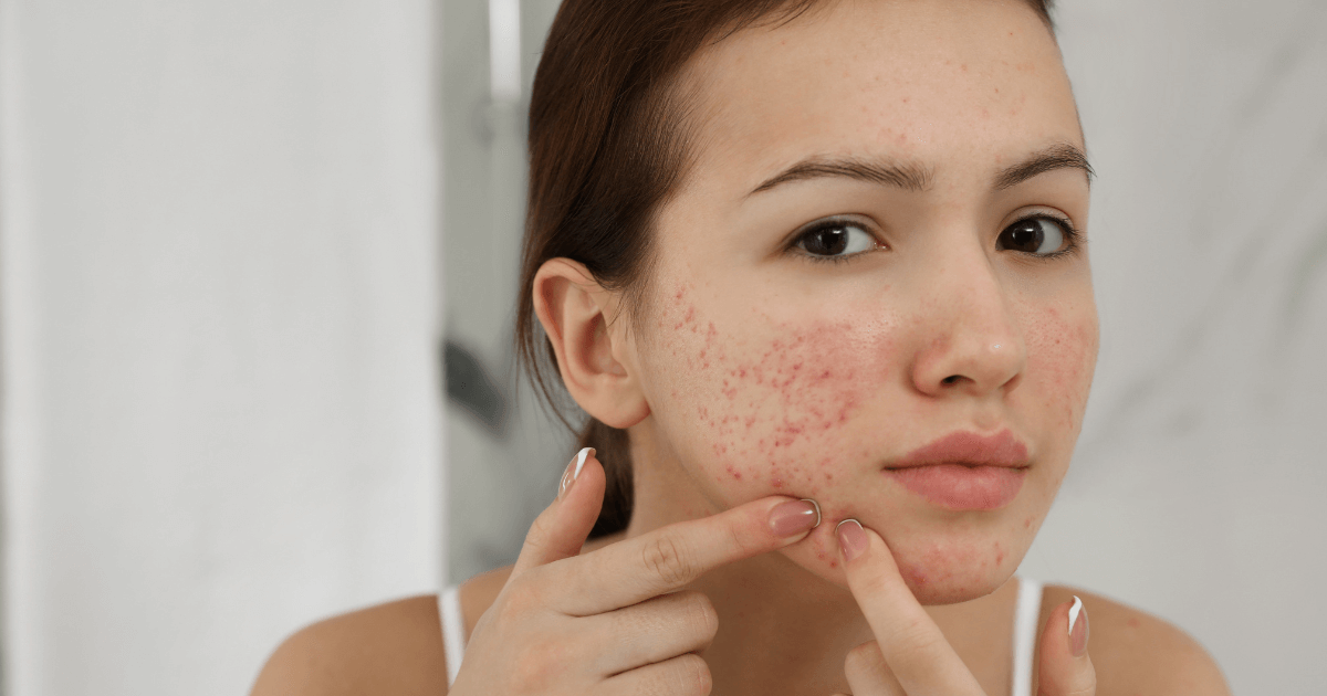 How to Remove Acne Scars Naturally